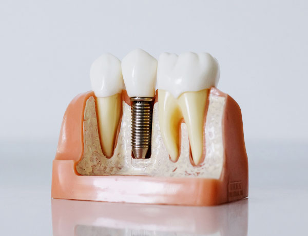 Dental implants